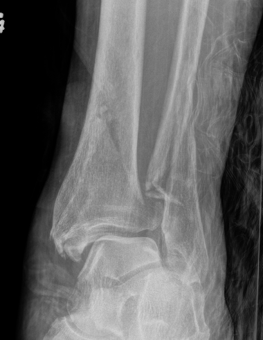 Tibial plafond fibular fracture